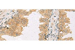 Immunohistochemistry of paraffin-embedded Human prost ate cancer tissue using SLC30A6 Polyclonal Antibody at dilution of 1:70(x200) (SLC30A6 抗体)