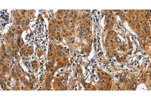 Immunohistochemistry of paraffin-embedded Human gastic cancer using BGN Polyclonal Antibody at dilution of 1:50 (Biglycan 抗体)