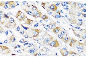 Immunohistochemistry of paraffin-embedded Human liver cancer using TSC2 Polyclonal Antibody at dilution of 1:200 (40x lens). (Tuberin 抗体)