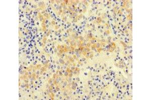 Immunohistochemistry of paraffin-embedded human lung cancer using ABIN7161144 at dilution of 1:100 (NEO1 抗体  (AA 414-682))