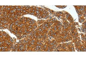 Immunohistochemistry of paraffin-embedded Human liver cancer using SSTR1 Polyclonal Antibody at dilution of 1:40 (SSTR1 抗体)