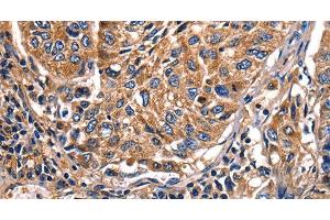 Immunohistochemistry of paraffin-embedded Human lung cancer tissue using Galectin 8 Polyclonal Antibody at dilution 1:50 (LGALS8 抗体)