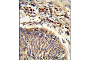 Formalin-fixed and paraffin-embedded human lung carcinoma reacted with HSPA6 Antibody , which was peroxidase-conjugated to the secondary antibody, followed by DAB staining. (HSPA6 抗体  (C-Term))