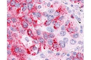 Anti-ESRRA / ERR Alpha antibody IHC of human Lung, Non-Small Cell Carcinoma. (ESRRA 抗体  (Ligand Binding Domain))