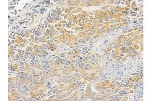 ABIN6265122 and ABIN6279093 at 1/100 staining human lung squamous cell carcinoma by IHC-P.