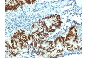 Formalin-fixed, paraffin-embedded human Colon Carcinoma stained with p53 Mouse Monoclonal Antibody (PAb1801). (p53 抗体)