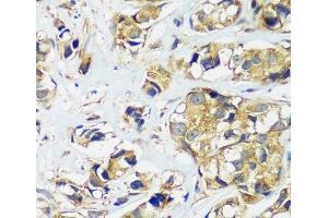 Immunohistochemistry of paraffin-embedded Human breast cancer using CCDC124 Polyclonal Antibody at dilution of 1:100 (40x lens). (CCDC124 抗体)