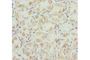 Immunohistochemistry of paraffin-embedded human gastric cancer using ABIN7168446 at dilution of 1:100 (ROBO3 抗体  (AA 1237-1386))