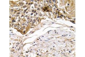 Immunohistochemistry of paraffin-embedded Human breast cancer using ARRB2 Polyclonal Antibody at dilution of 1:200 (40x lens). (Arrestin 3 抗体)