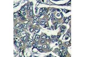 IHC analysis of formalin fixed paraffin embedded human breast carcinoma stained with EIF4E2 antibody