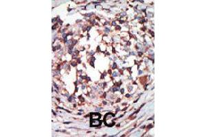 Formalin-fixed and paraffin-embedded human cancer tissue reacted with PRKCB polyclonal antibody  , which was peroxidase-conjugated to the secondary antibody, followed by AEC staining . (PKC beta 抗体  (C-Term))