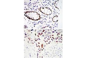 Immunohistochemical analysis of paraffin-embedded human colon cancer tissues (upper) and lung cancer tissues (bottom) using KLF4 monoclonal antibody, clone 1E6  with DAB staining. (KLF4 抗体)