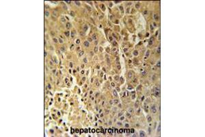 DHB13 Antibody immunohistochemistry analysis in formalin fixed and paraffin embedded human hepatocarcinoma followed by peroxidase conjugation of the secondary antibody and DAB staining. (HSD17B13 抗体  (N-Term))