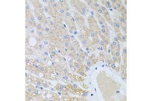 Immunohistochemistry of paraffin-embedded human liver injury using DLK1 antibody (ABIN2562237) at dilution of 1:100 (40x lens).