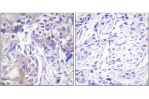 Immunohistochemistry analysis of paraffin-embedded human breast carcinoma tissue, using ADD1 (Ab-445) Antibody. (alpha Adducin 抗体  (AA 411-460))