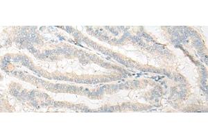 Immunohistochemistry of paraffin-embedded Human thyroid cancer tissue using DNASE1L1 Polyclonal Antibody at dilution of 1:25(x200) (DNASEX 抗体)
