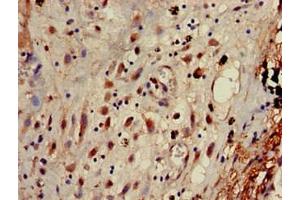 Immunohistochemistry of paraffin-embedded human lung cancer using ABIN7144346 at dilution of 1:100 (gamma 1 Adaptin 抗体  (AA 592-686))