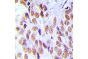 Immunohistochemical analysis of HMGB1 staining in human breast cancer formalin fixed paraffin embedded tissue section. (HMGB1 抗体)