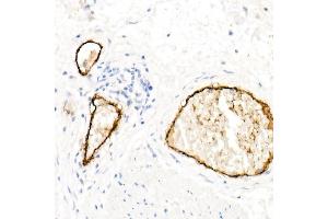 Immunohistochemistry of paraffin-embedded Human esophageal cancer using von Willebrand factor (VWF) antibody (ABIN7271339) at dilution of 1:800 (40x lens). (VWF 抗体)