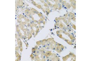 Immunohistochemistry of paraffin-embedded human stomach using ABCF2 antibody (ABIN5972445) at dilution of 1/100 (40x lens). (ABCF2 抗体)