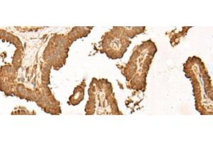 Immunohistochemistry of paraffin-embedded Human thyroid cancer tissue using ZBTB43 Polyclonal Antibody at dilution of 1:40(x200) (ZBTB43 抗体)