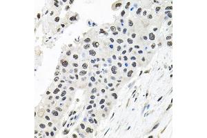 Immunohistochemistry of paraffin-embedded human lung cancer using CDCA8 antibody. (CDCA8 抗体)