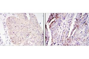 Immunohistochemical analysis of paraffin-embedded ovary tumour tissues (left) and lung cancer (right) using CRTC2 mouse mAb with DAB staining.