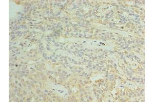 Immunohistochemistry of paraffin-embedded human breast cancer using ABIN7170641 at dilution of 1:100 (RBM11 抗体  (AA 115-278))