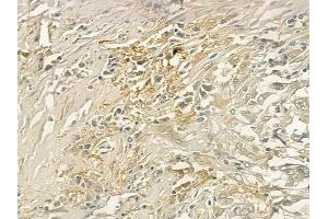 ABIN6258907 and ABIN6274153 at 1/100 staining human lung squamous cell carcinoma by IHC-P.