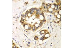 Immunohistochemistry of paraffin-embedded human liver cancer using RPH3A antibody (ABIN6128668, ABIN6147094, ABIN6147096 and ABIN6217639) at dilution of 1:100 (40x lens). (RPH3A 抗体  (AA 1-280))