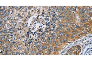 Immunohistochemistry of paraffin-embedded Human cervical cancer tissue using ZMYND11 Polyclonal Antibody at dilution 1:70 (ZMYND11 抗体)