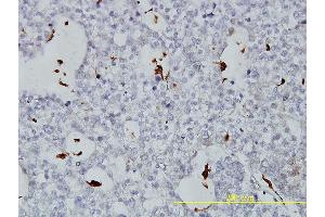 Immunoperoxidase of monoclonal antibody to PLTP on formalin-fixed paraffin-embedded human ovary, clear cell carcinoma tissue. (PLTP 抗体  (AA 19-441))