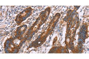 Immunohistochemistry of paraffin-embedded Human colon cancer using CLP36 Polyclonal Antibody at dilution of 1:30 (PDLIM1 抗体)