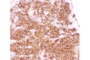 IHC-P: p50 antibody testing of human lung cancer tissue (CD40 抗体  (AA 1-360))