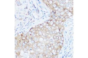 Immunohistochemistry of paraffin-embedded human breast cancer using EIF4G1 Rabbit pAb (ABIN6134646, ABIN6140092, ABIN6140093 and ABIN6221701) at dilution of 1:100 (40x lens). (EIF4G1 抗体  (AA 400-500))