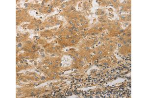 Immunohistochemistry of Human lung cancer using PPAP2A Polyclonal Antibody at dilution of 1:50