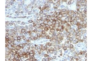 Formalin-fixed, paraffin-embedded human melanoma stained with Melanoma antibody. (Melanoma 抗体)