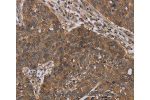 Immunohistochemistry of Human lung cancer using OXTR Polyclonal Antibody at dilution of 1:40 (Oxytocin Receptor 抗体)