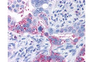 Anti-GPR6 antibody IHC of human Lung, Adenocarcinoma. (GPR6 抗体  (Cytoplasmic Domain))