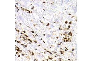 Immunohistochemistry of paraffin-embedded human kidney cancer using SUMO4 Antibody. (SUMO4 抗体)