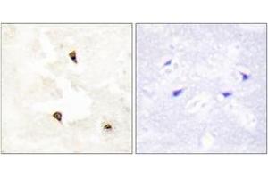 Immunohistochemistry analysis of paraffin-embedded human breast carcinoma tissue, using TP53I11 Antibody. (TP53I11 抗体  (AA 71-120))