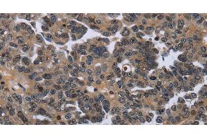 Immunohistochemistry of paraffin-embedded Human ovarian cancer using ITGAE Polyclonal Antibody at dilution of 1:50 (CD103 抗体)