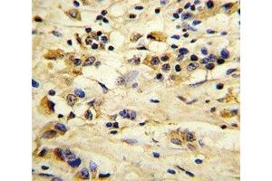 IHC analysis of FFPE human breast carcinoma stained with EIF4E2 antibody (EIF4E2 抗体)