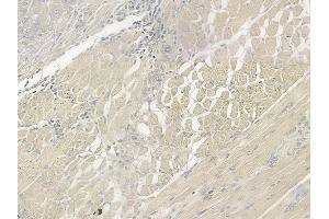 ABIN6266286 and ABIN6277442 at 1/100 staining human tongue carcinoma by IHC-P.
