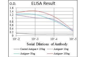 Immunohistochemical analysis of paraffin-embedded cervical cancer tissues using TWIST1 antibody with DAB staining.
