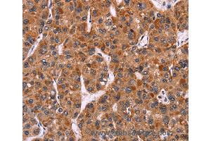 Immunohistochemistry of Human colon cancer using CARD11 Polyclonal Antibody at dilution of 1:40 (CARD11 抗体)