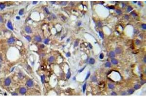 Immunohistochemistry (IHC) analyzes of p-c-RAF (pSer259) pAb in paraffin-embedded human prostate carcinoma tissue. (RAF1 抗体  (pSer259))
