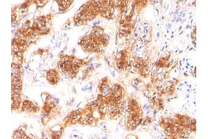 Formalin-fixed, paraffin-embedded human Breast Carcinoma stained with Milk Fat Globule Monoclonal Antibody (SPM291) (MFGE8 抗体)