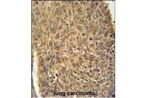 ATG13 Antibody (N-term) (ABIN653882 and ABIN2843129) immunohistochemistry analysis in formalin fixed and paraffin embedded human lung carcinoma followed by peroxidase conjugation of the secondary antibody and DAB staining. (ATG13 抗体  (N-Term))