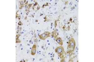 Immunohistochemistry of paraffin-embedded human liver cancer using GATM Antibody (ABIN5973965) at dilution of 1/100 (40x lens). (GATM 抗体)